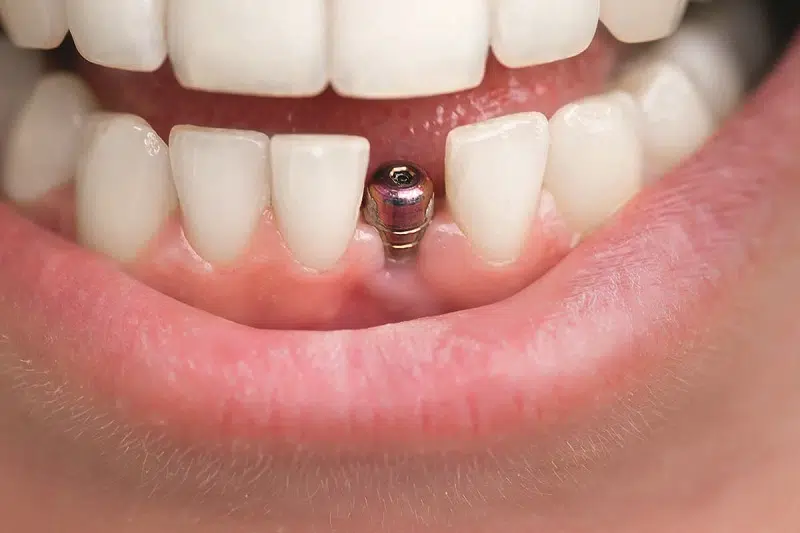 Comment est mis un implant dentaire