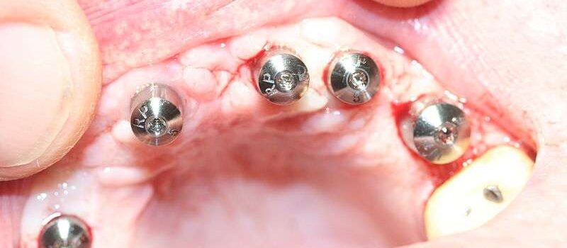 Comment est mis un implant dentaire ?