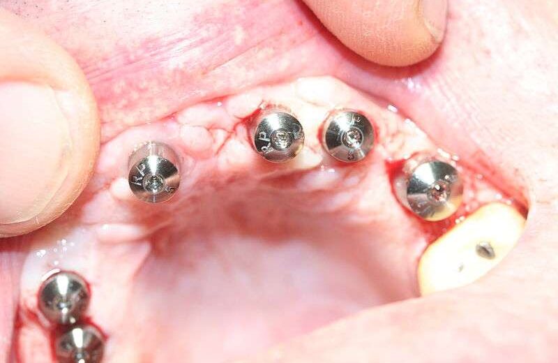 Comment est mis un implant dentaire ?
