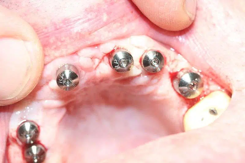 Comment est mis un implant dentaire ?